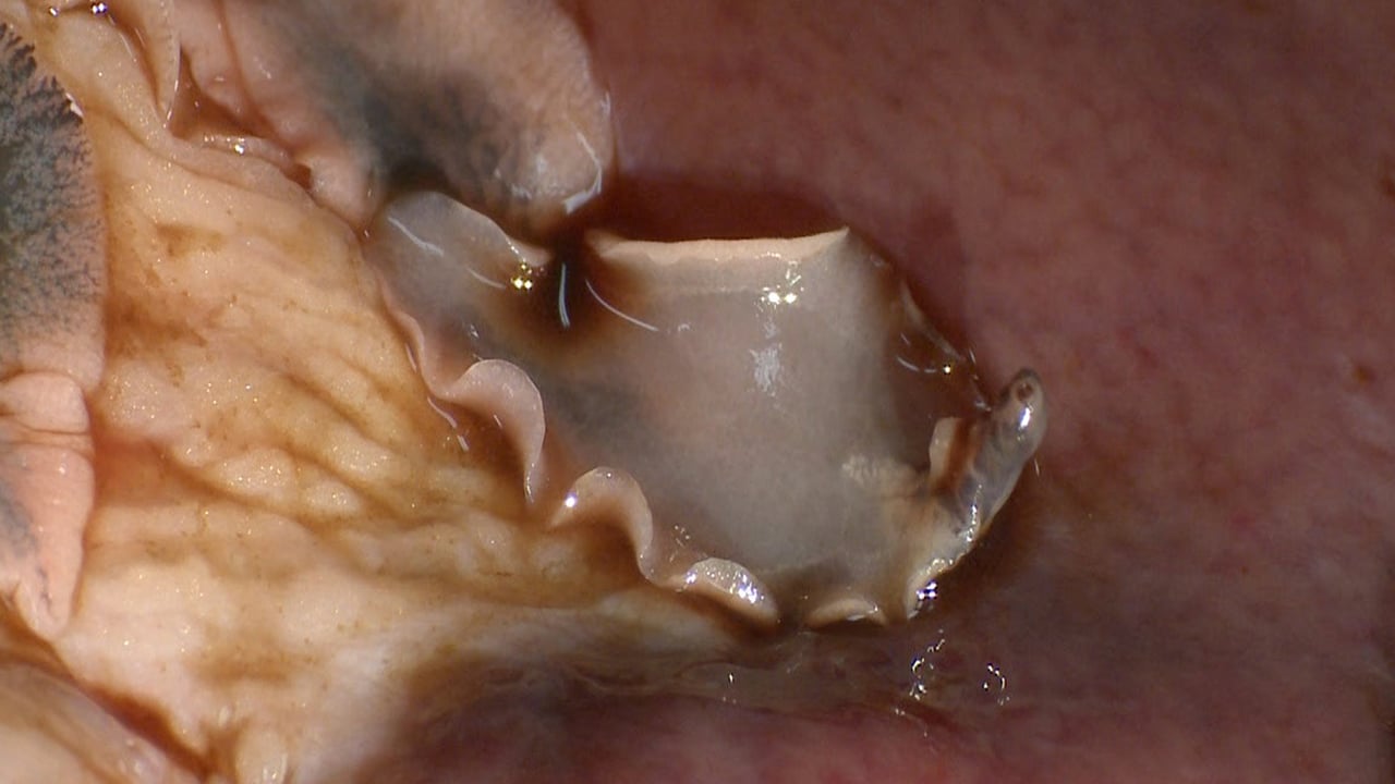 Fluke-mapping research has the potential to revolutionise treatment