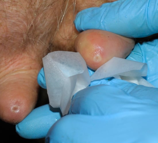 Are antibiotics masking poor drying off techniques?