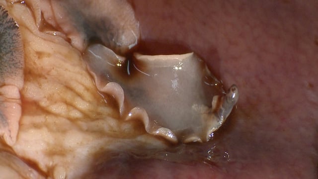 Fluke-mapping research has the potential to revolutionise treatment